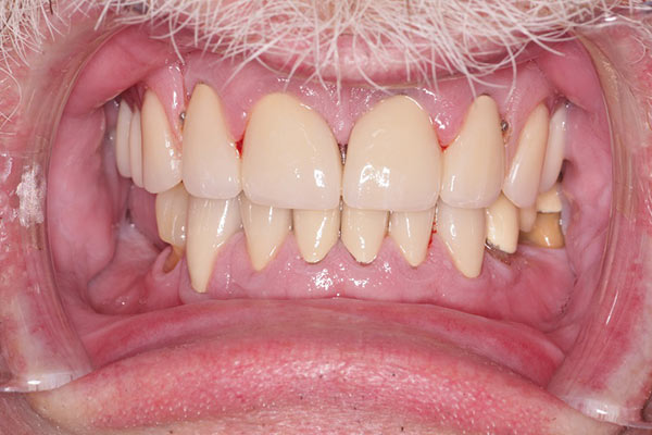 Smile Gallery - After