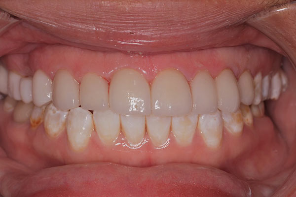 Smile Gallery - After