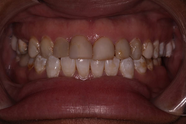 Smile Gallery - Before