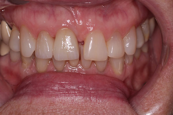 Smile Gallery - After