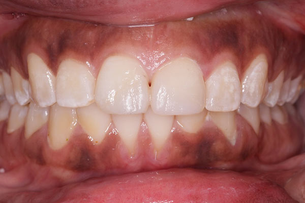 Smile Gallery - After