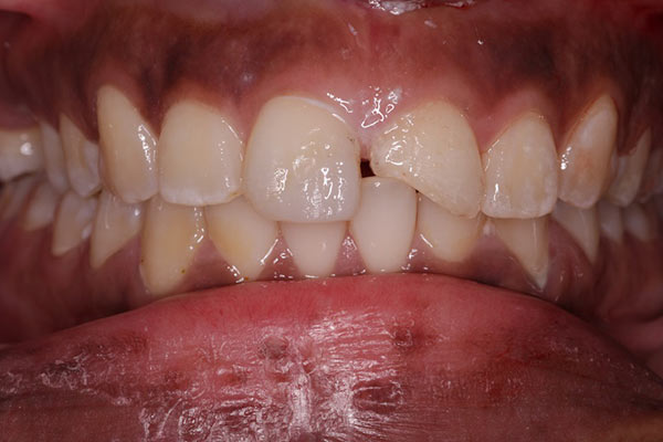 Smile Gallery - Before