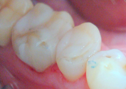 Smile Gallery - After